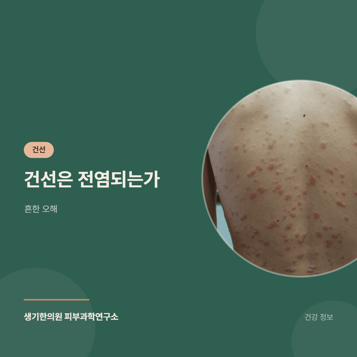 건선은 전염되는가 — 흔한 오해 대표 이미지
