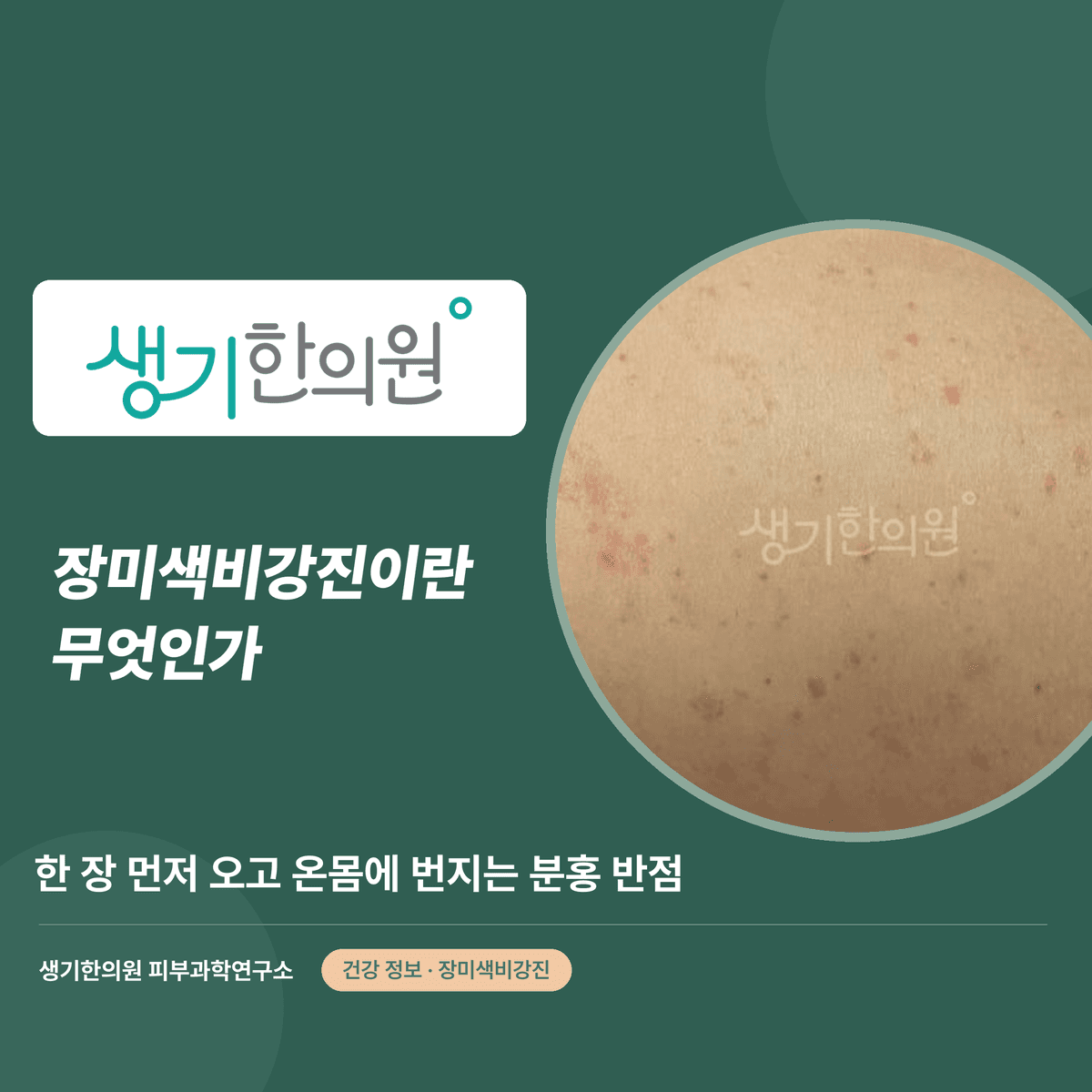 장미색비강진이란 무엇인가 — 한 장 먼저 오고 온몸에 번지는 분홍 반점 대표 이미지