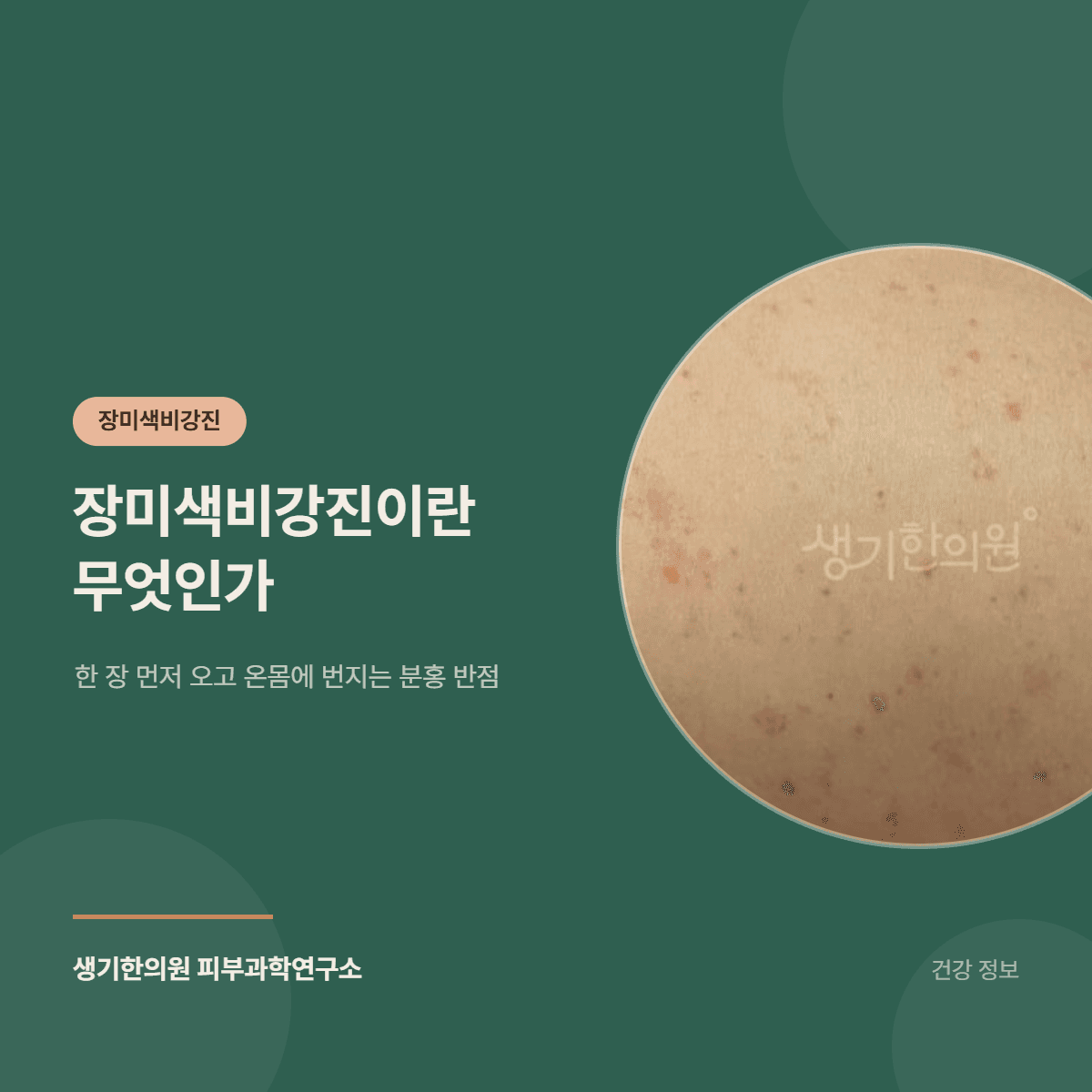 장미색비강진이란 무엇인가 — 한 장 먼저 오고 온몸에 번지는 분홍 반점 대표 이미지
