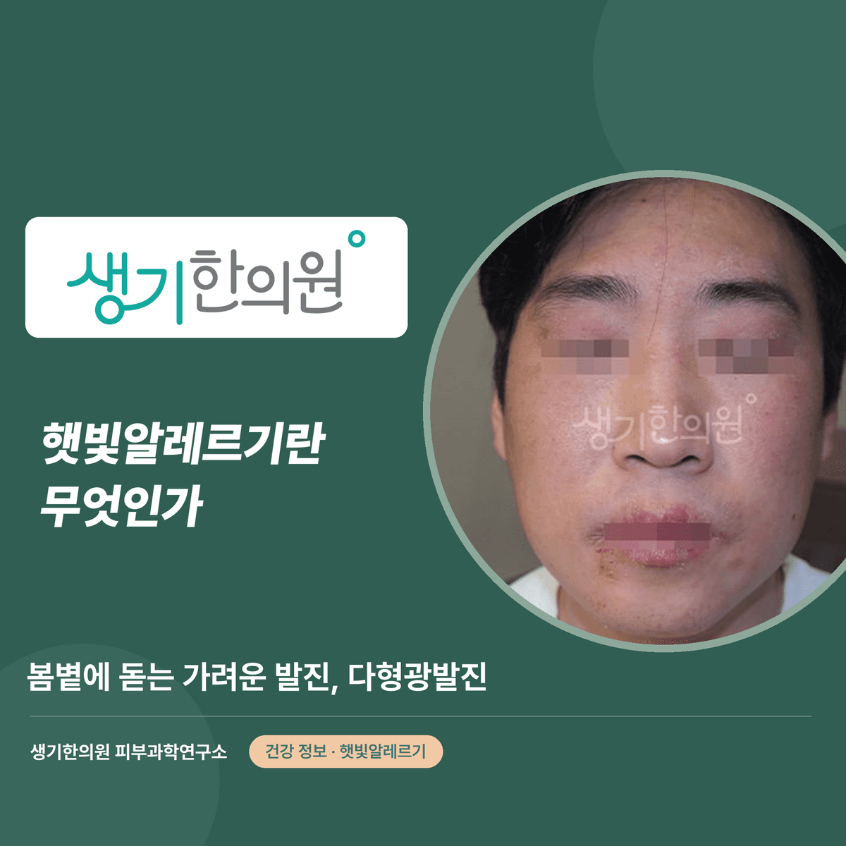 햇빛알레르기란 무엇인가 — 봄볕에 돋는 가려운 발진, 다형광발진 대표 이미지