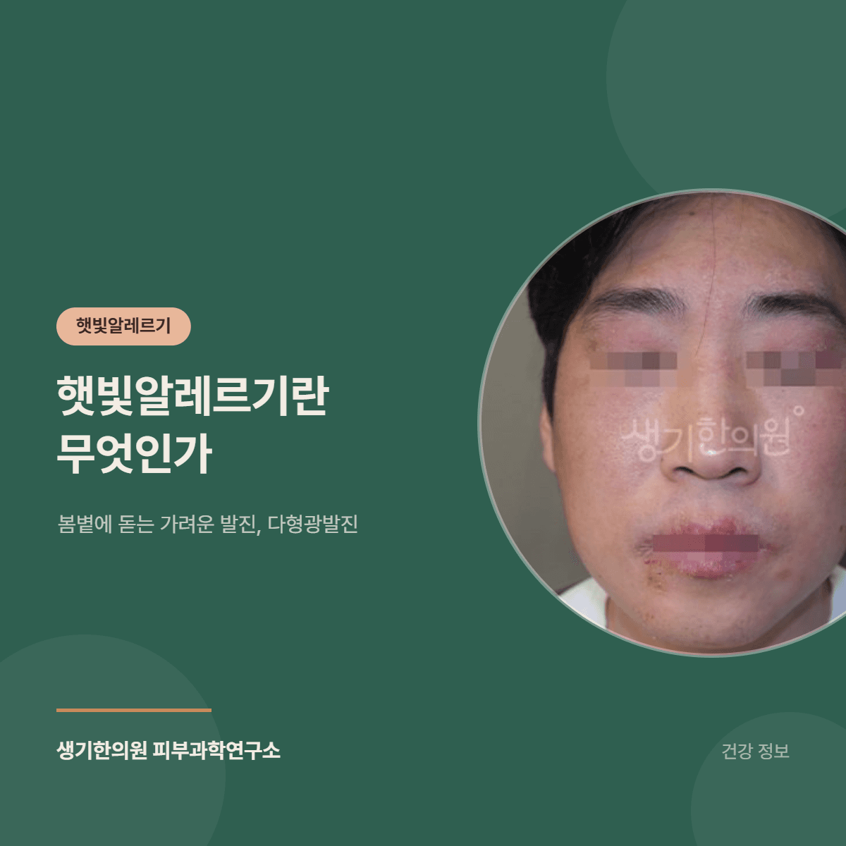 햇빛알레르기란 무엇인가 — 봄볕에 돋는 가려운 발진, 다형광발진 대표 이미지