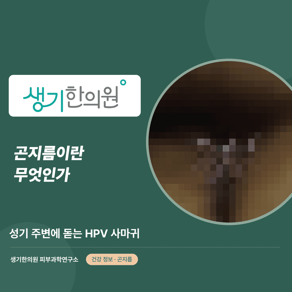 곤지름이란 무엇인가 — 성기 주변에 돋는 HPV 사마귀 대표 이미지