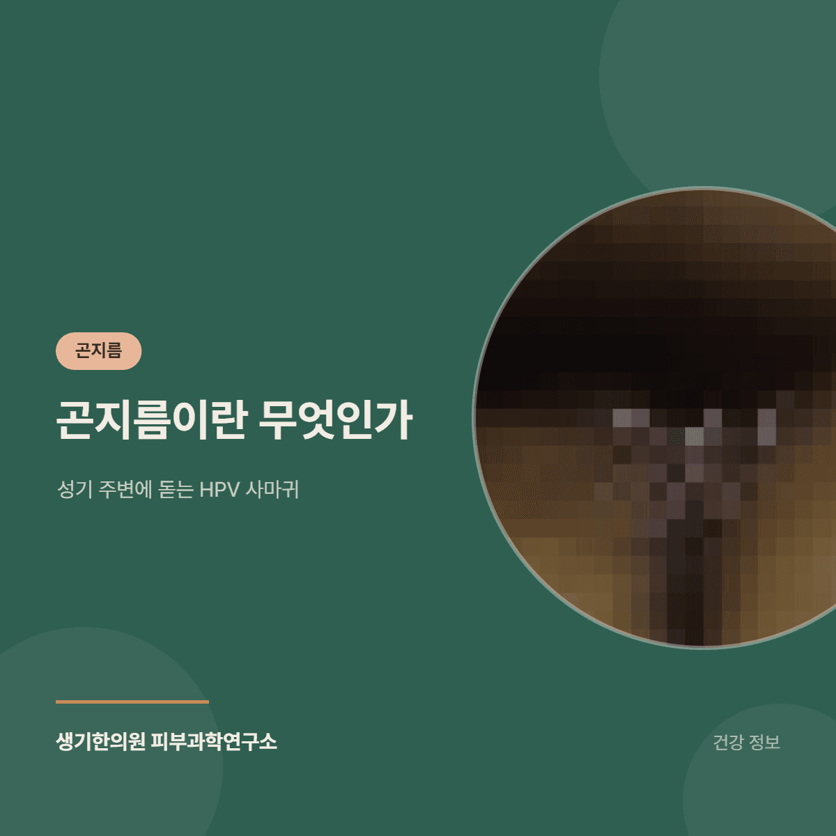곤지름이란 무엇인가 — 성기 주변에 돋는 HPV 사마귀 대표 이미지