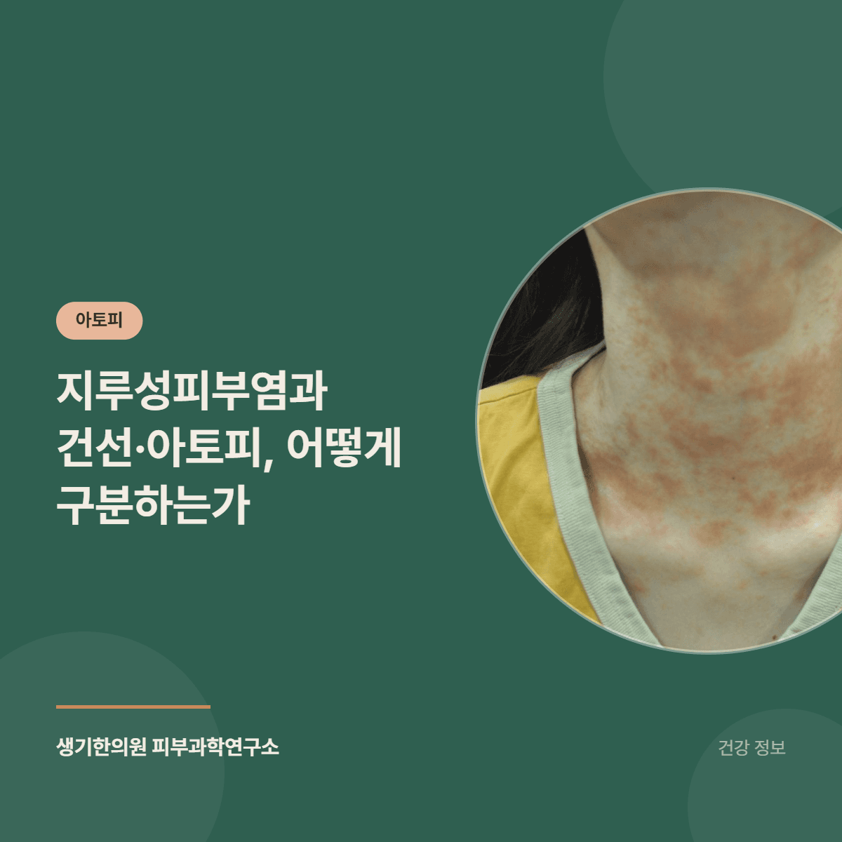 지루성피부염과 건선·아토피, 어떻게 구분하는가 대표 이미지