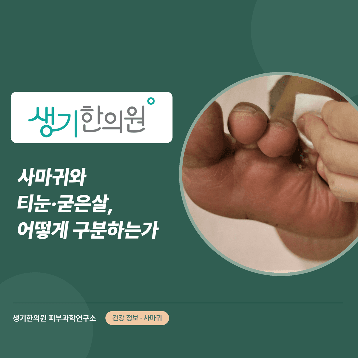 사마귀와 티눈·굳은살, 어떻게 구분하는가 대표 이미지