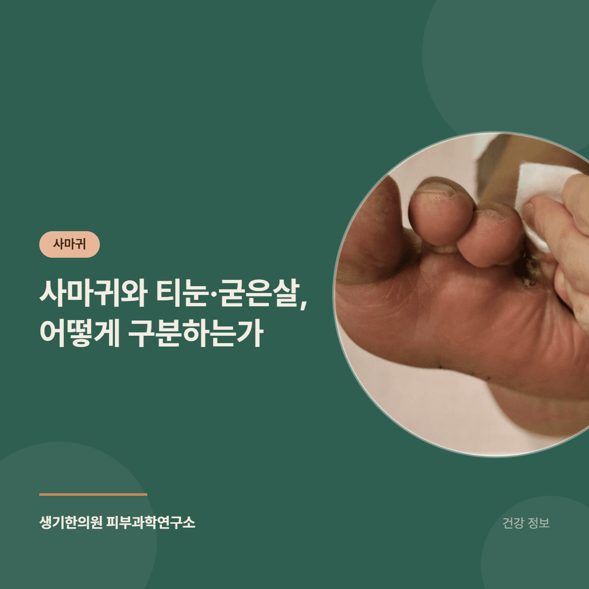 사마귀와 티눈·굳은살, 어떻게 구분하는가 대표 이미지