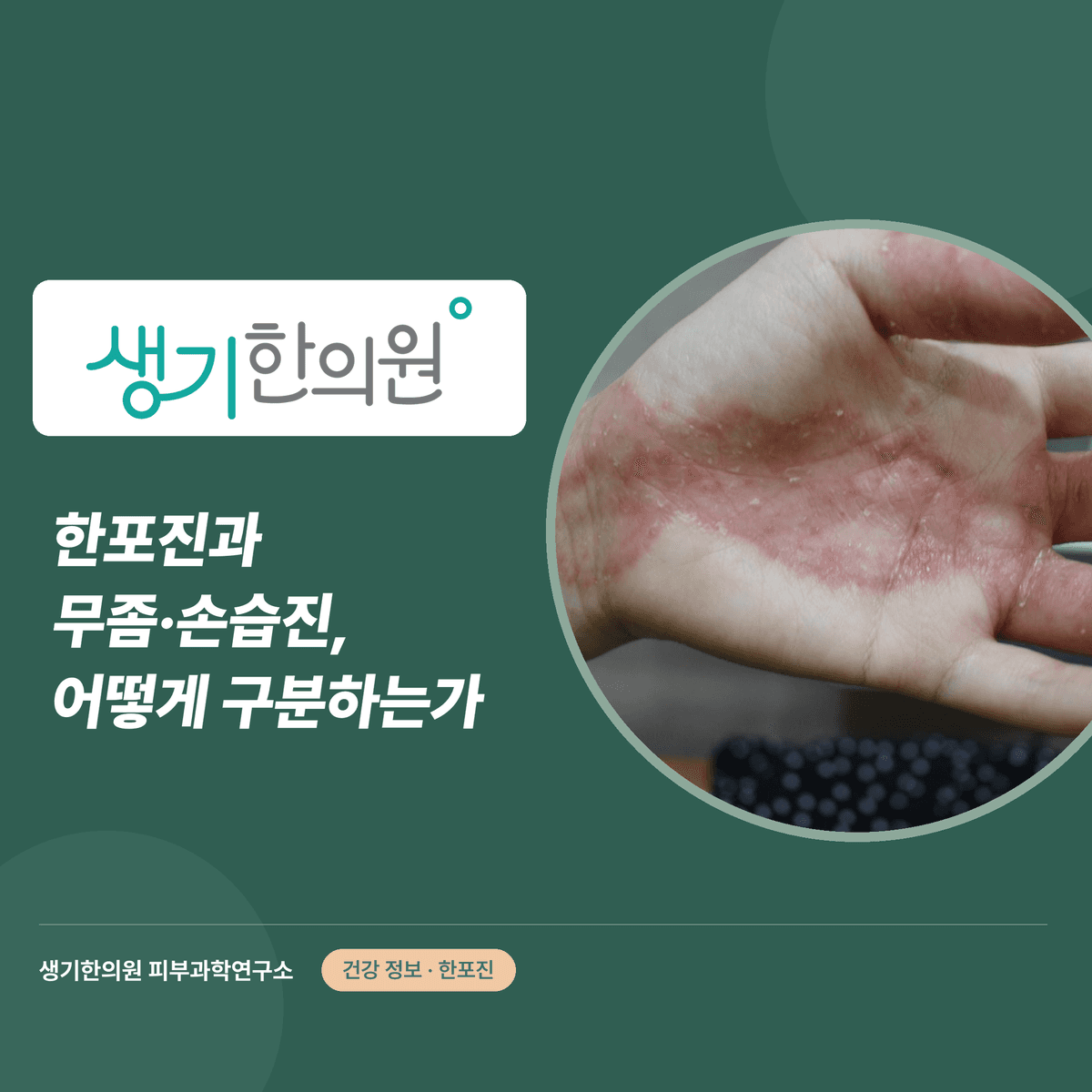 한포진과 무좀·손습진, 어떻게 구분하는가 대표 이미지
