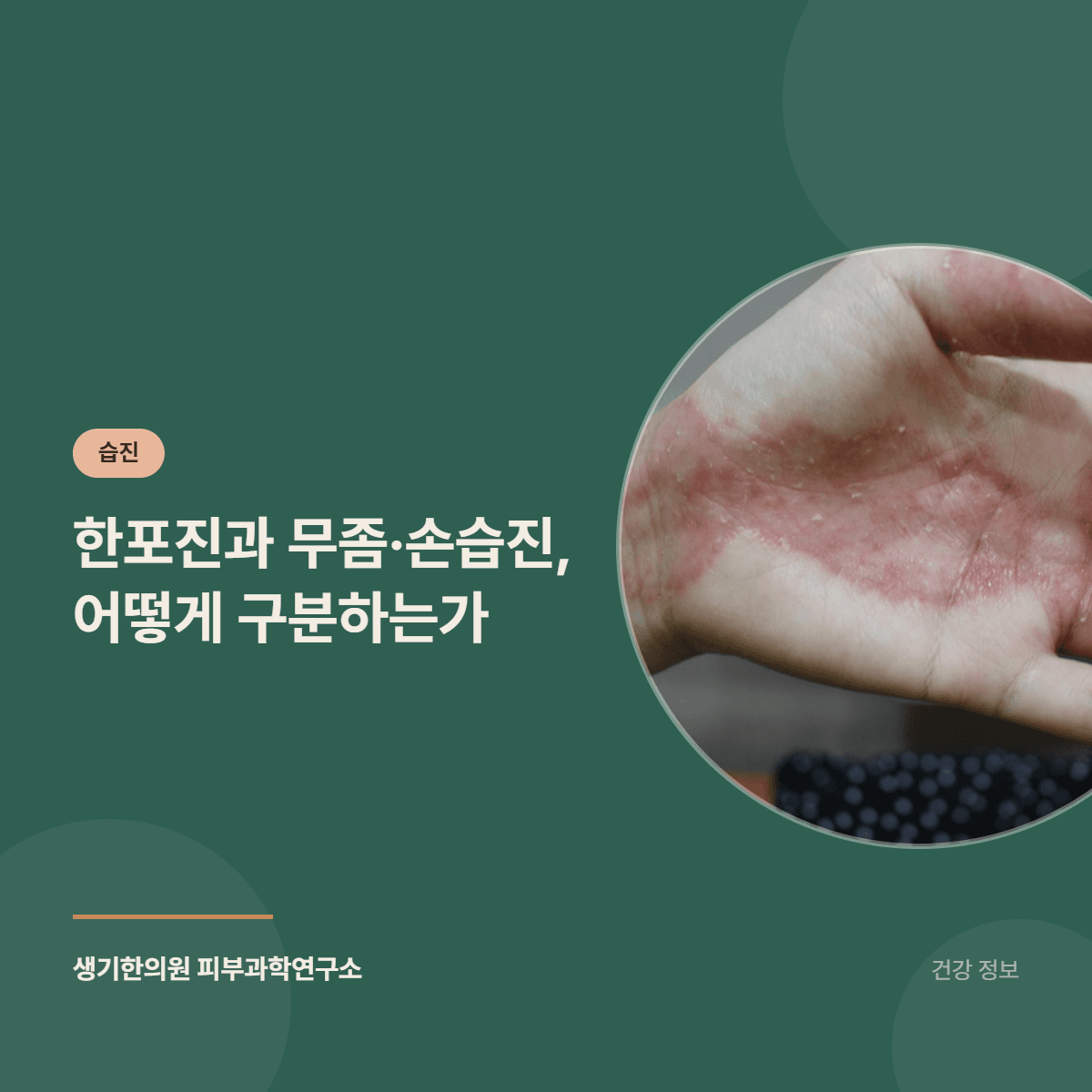 한포진과 무좀·손습진, 어떻게 구분하는가 대표 이미지
