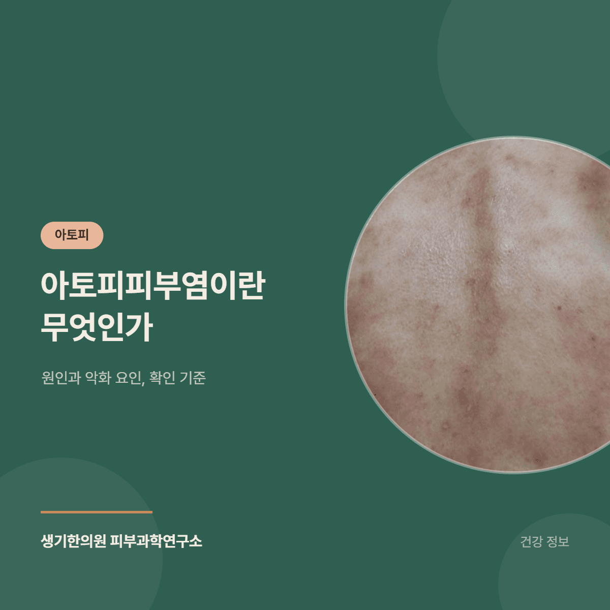 아토피피부염이란 무엇인가 — 원인과 악화 요인, 확인 기준 대표 이미지