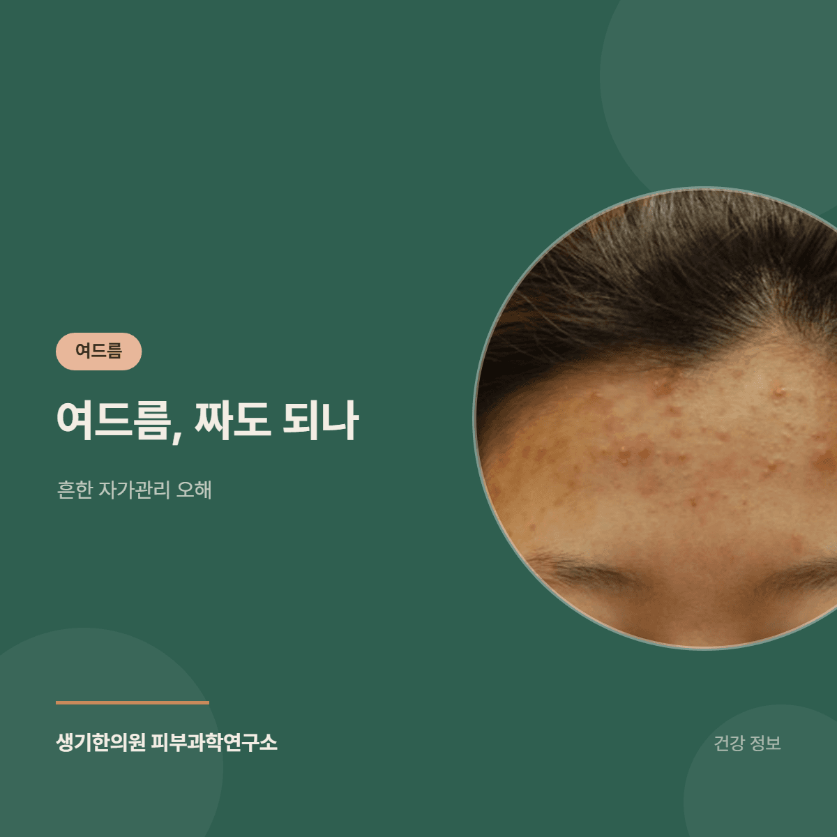여드름, 짜도 되나 — 흔한 자가관리 오해 대표 이미지