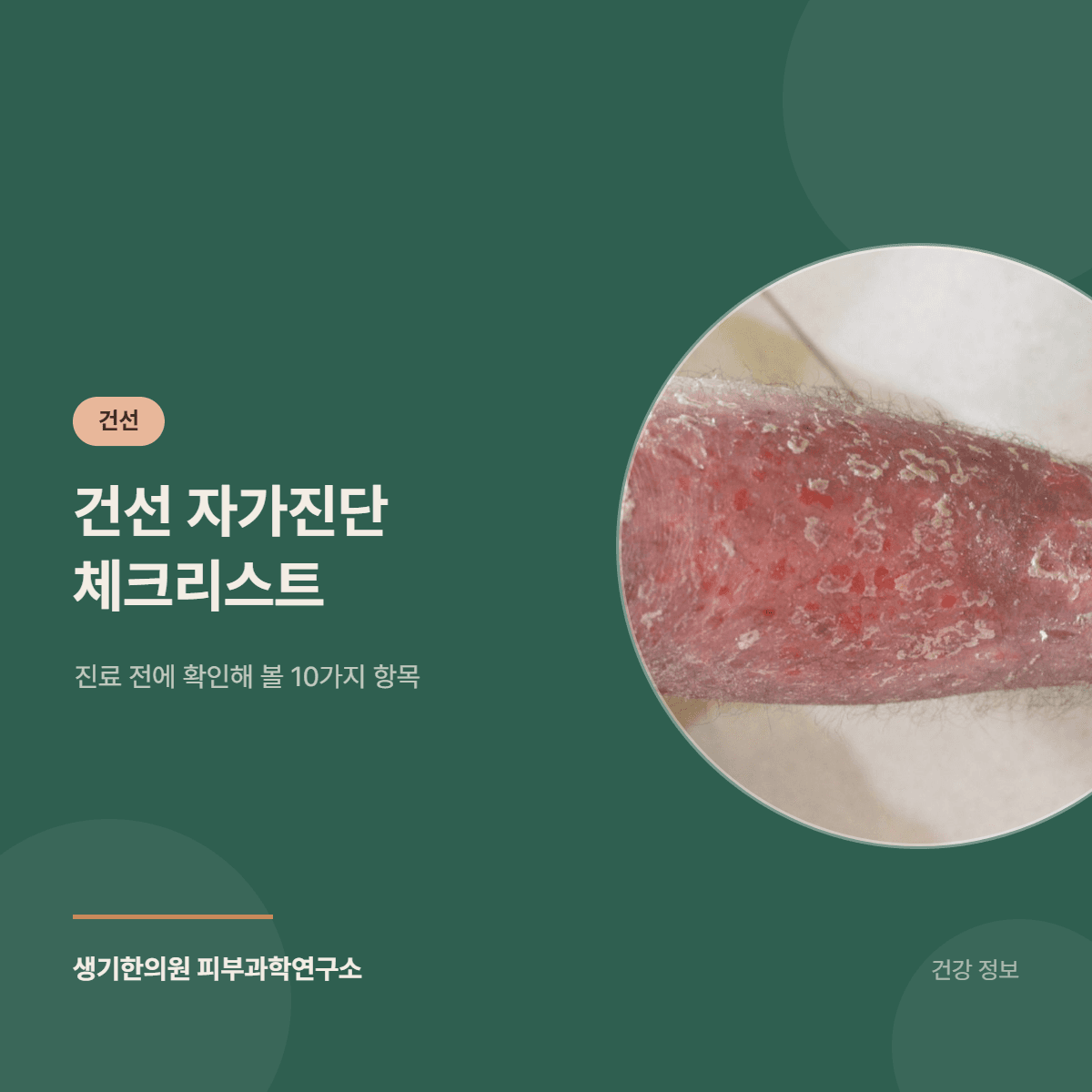 건선 자가진단 체크리스트 — 진료 전에 확인해 볼 10가지 항목 대표 이미지
