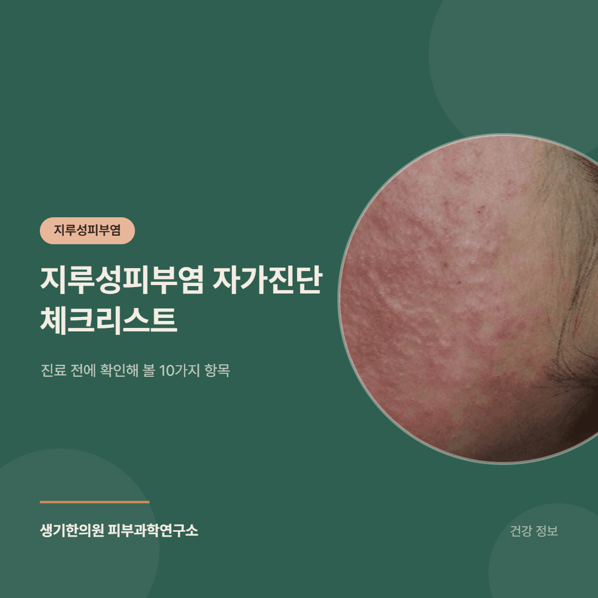 지루성피부염 자가진단 체크리스트 — 진료 전에 확인해 볼 10가지 항목 대표 이미지