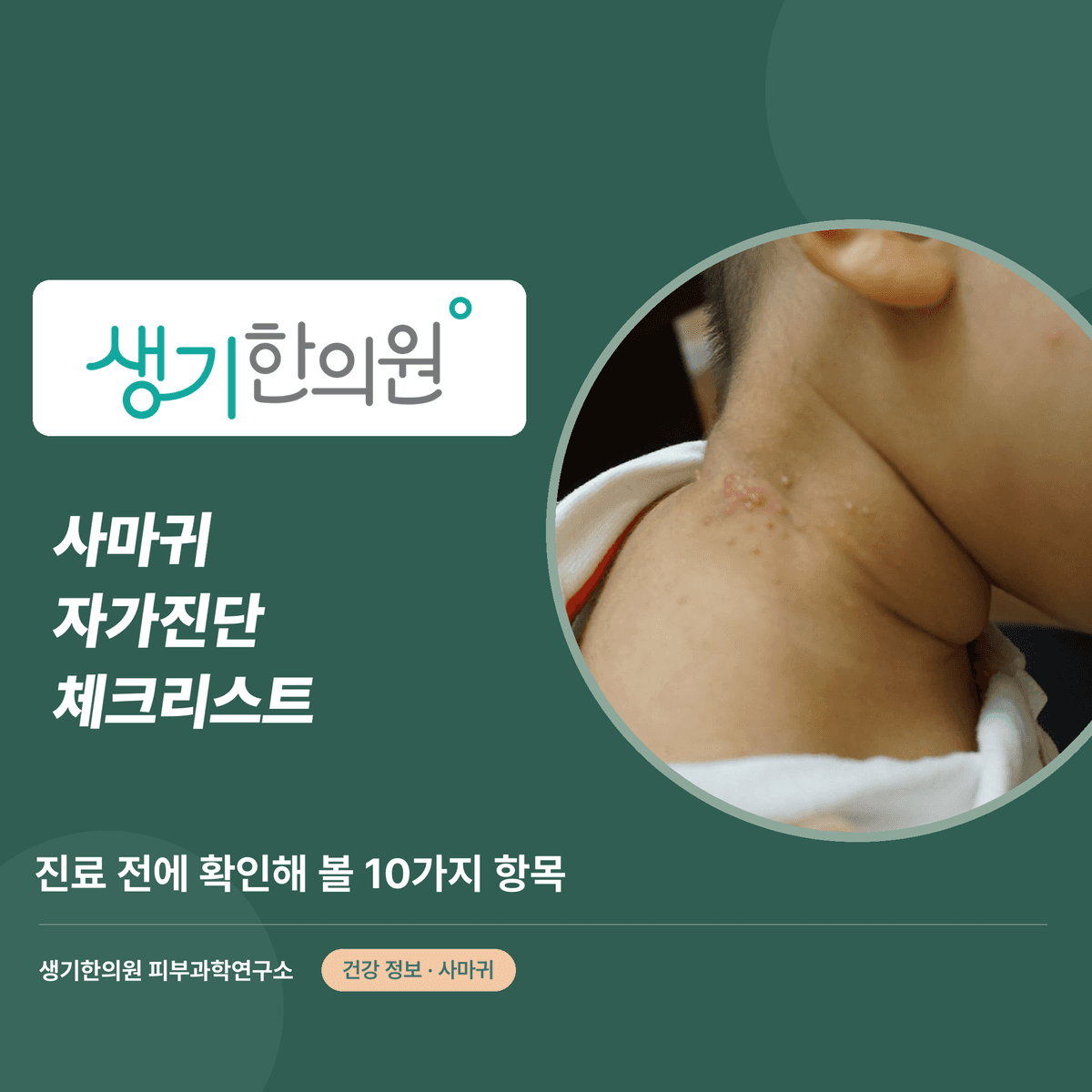 사마귀 자가진단 체크리스트 — 진료 전에 확인해 볼 10가지 항목 대표 이미지