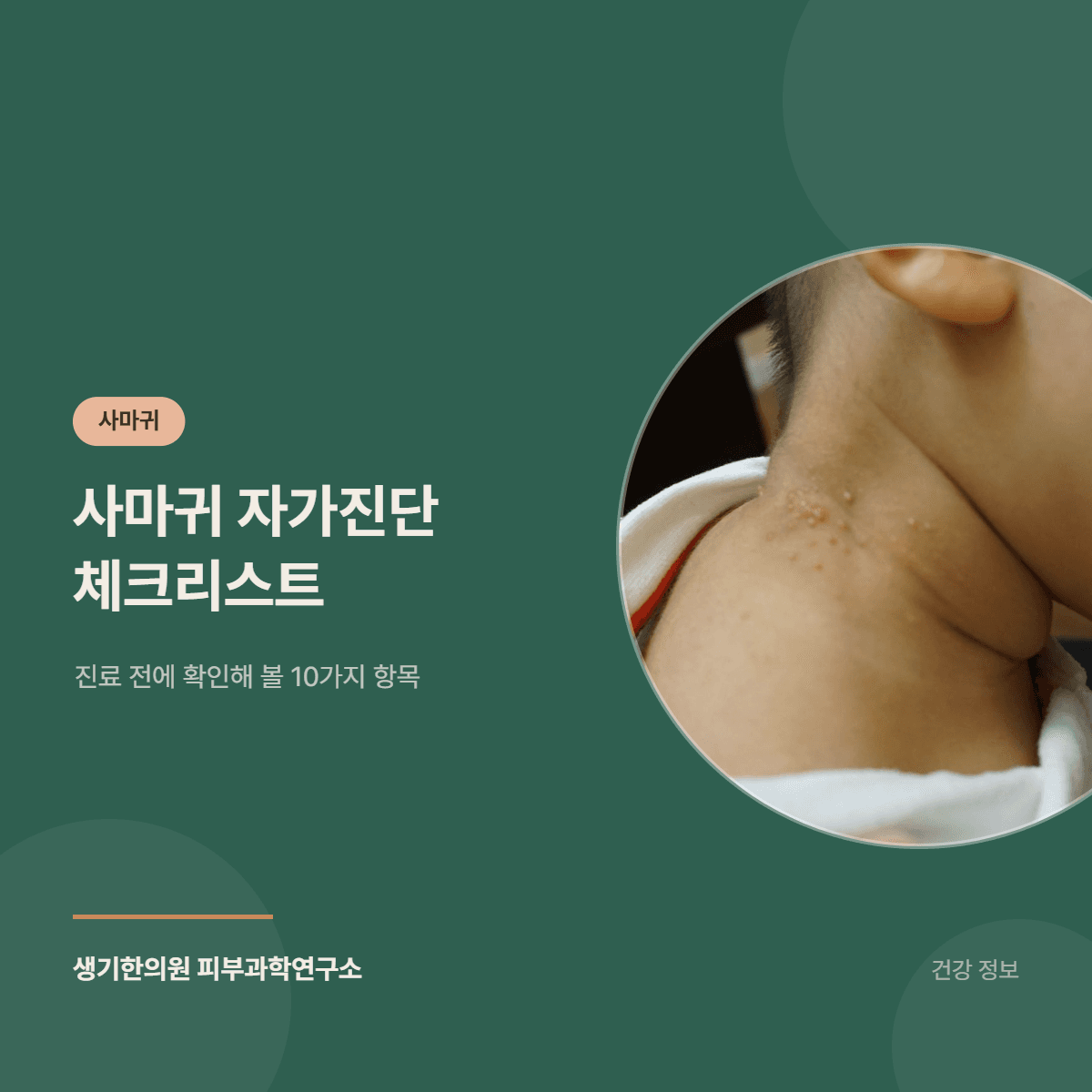 사마귀 자가진단 체크리스트 — 진료 전에 확인해 볼 10가지 항목 대표 이미지
