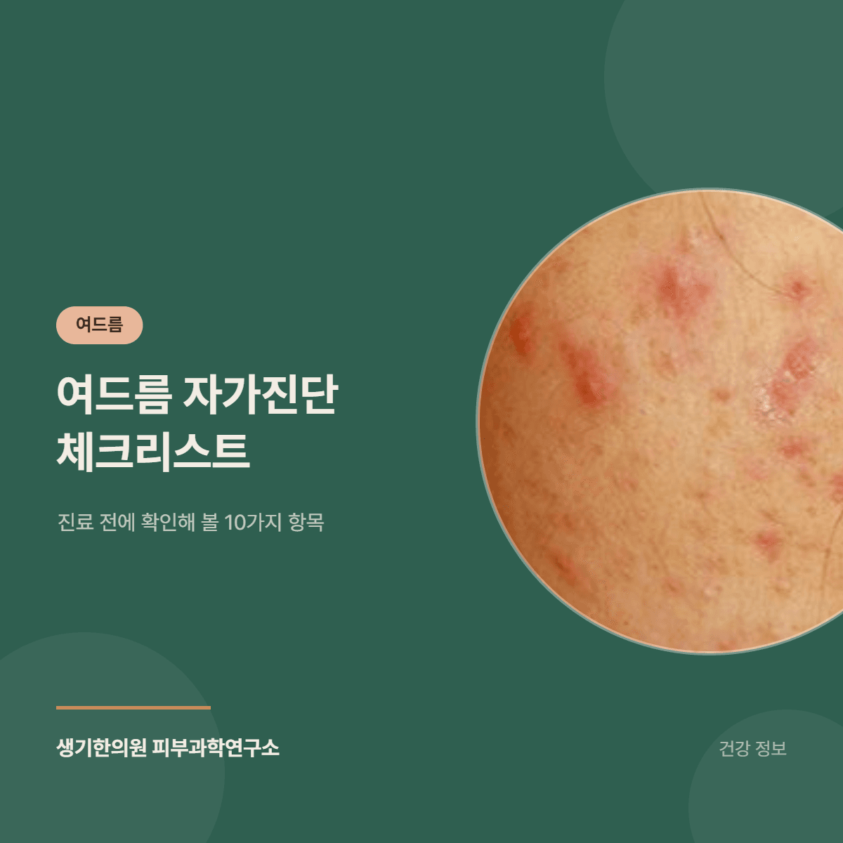 여드름 자가진단 체크리스트 — 진료 전에 확인해 볼 10가지 항목 대표 이미지