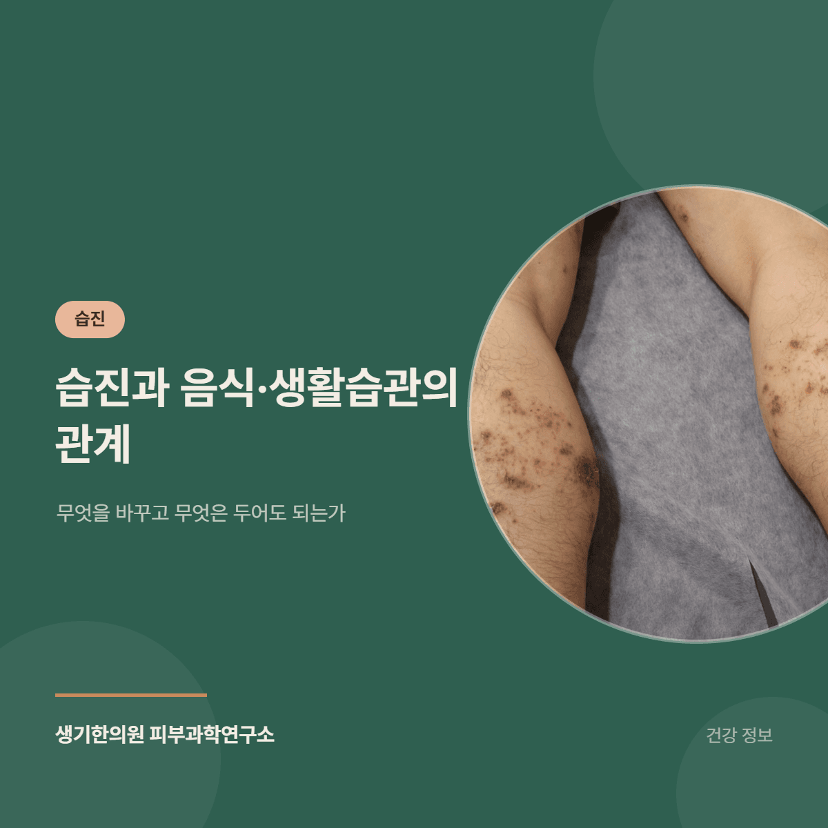 습진과 음식·생활습관의 관계 — 무엇을 바꾸고 무엇은 두어도 되는가 대표 이미지