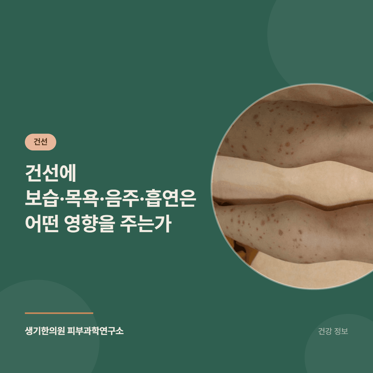 건선에 보습·목욕·음주·흡연은 어떤 영향을 주는가 대표 이미지