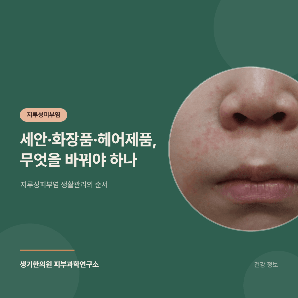 세안·화장품·헤어제품, 무엇을 바꿔야 하나 — 지루성피부염 생활관리의 순서 대표 이미지