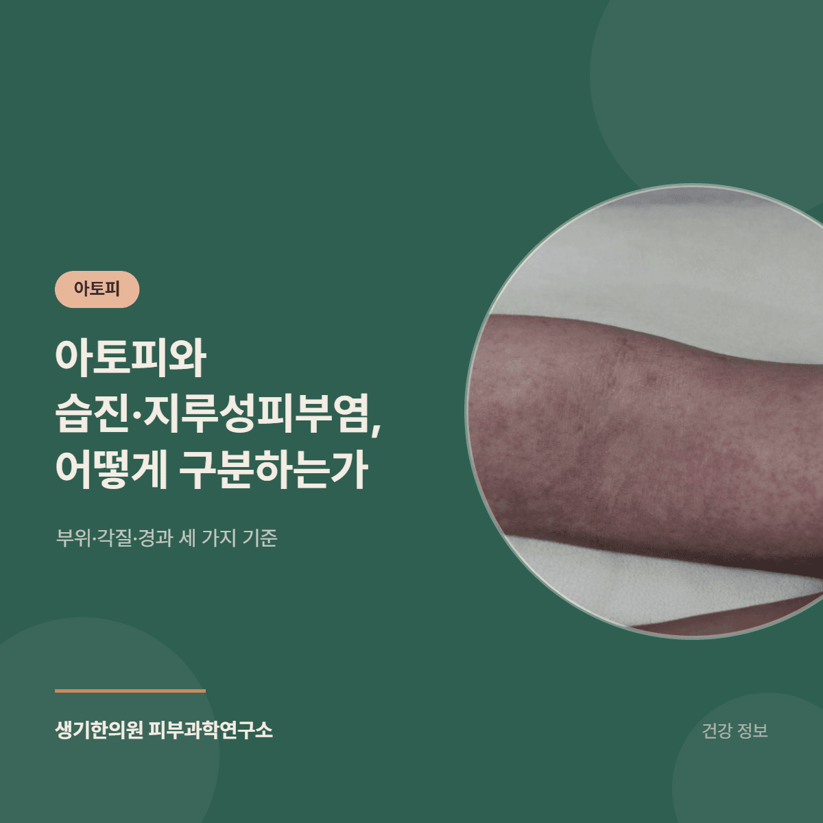 아토피와 습진·지루성피부염, 어떻게 구분하는가 — 부위·각질·경과 세 가지 기준 대표 이미지