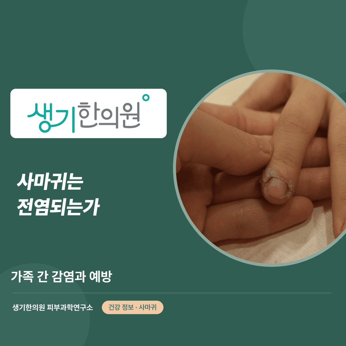 사마귀는 전염되는가 — 가족 간 감염과 예방 대표 이미지