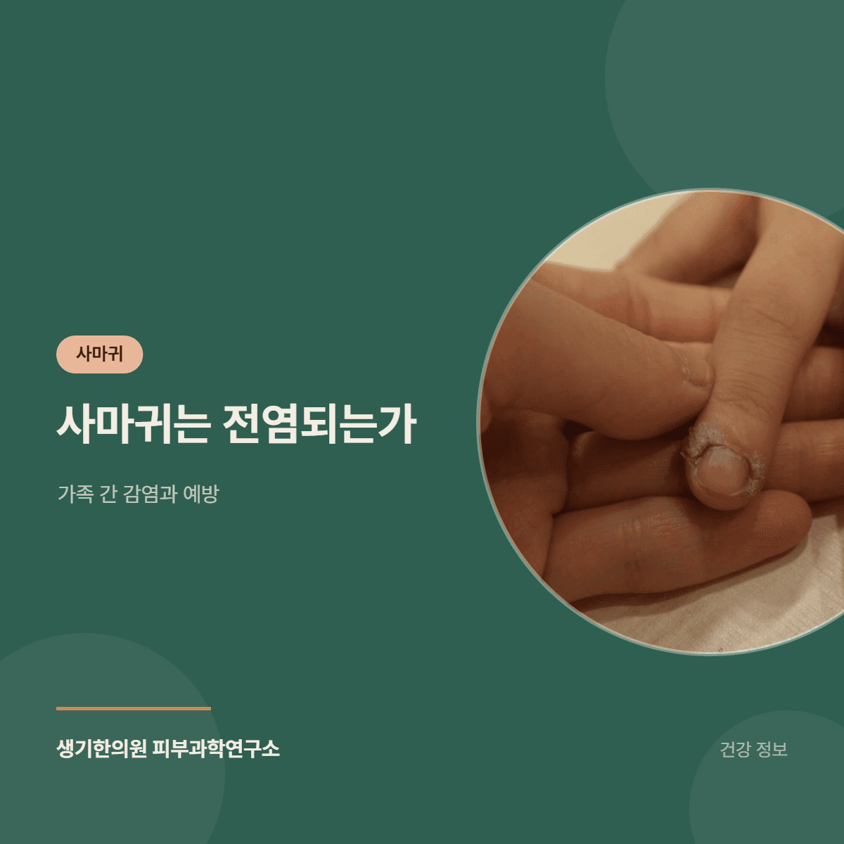 사마귀는 전염되는가 — 가족 간 감염과 예방 대표 이미지