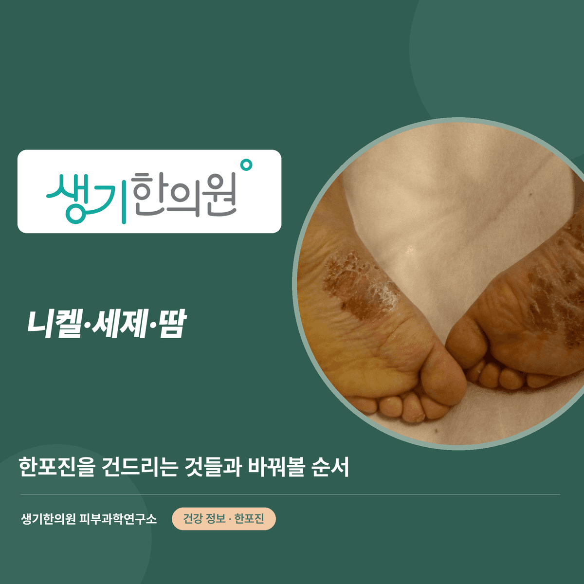 니켈·세제·땀 — 한포진을 건드리는 것들과 바꿔볼 순서 대표 이미지