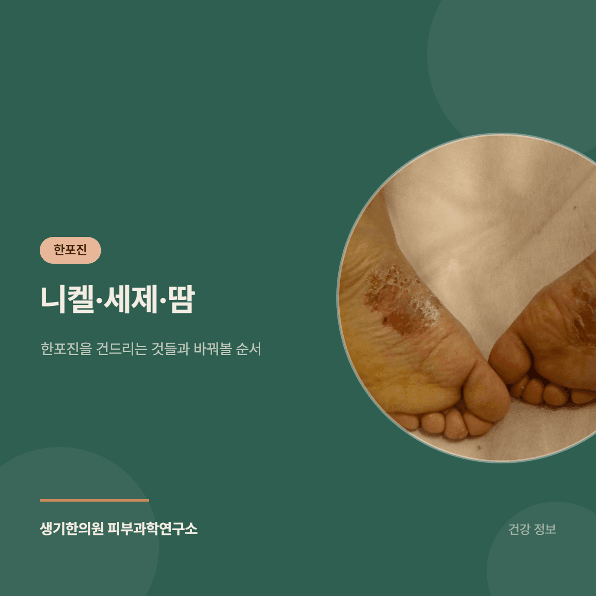 니켈·세제·땀 — 한포진을 건드리는 것들과 바꿔볼 순서 대표 이미지