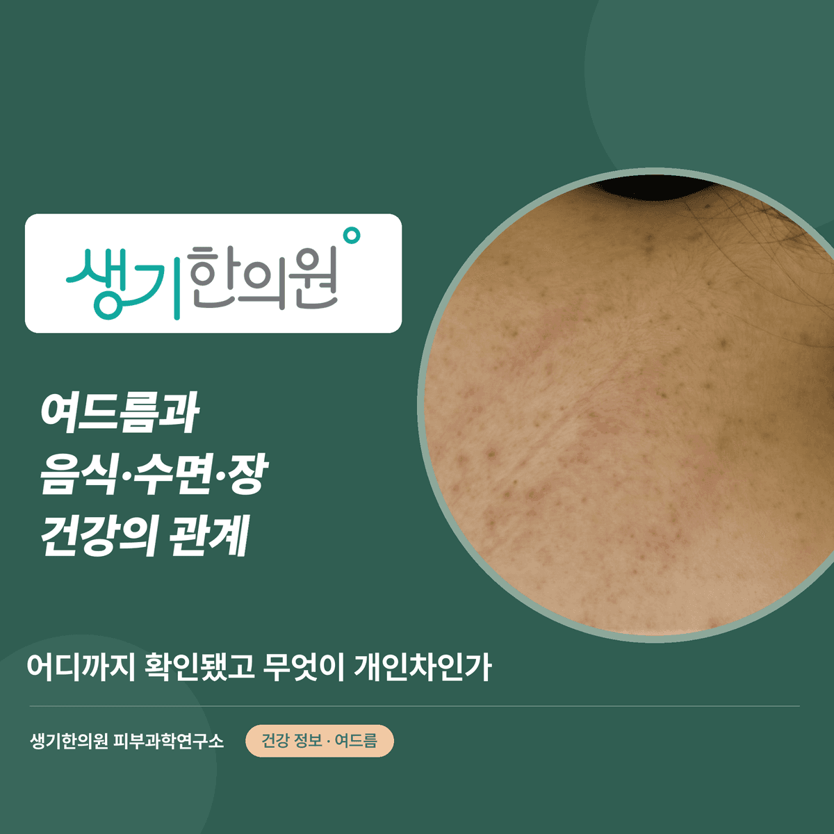 여드름과 음식·수면·장 건강의 관계 — 어디까지 확인됐고 무엇이 개인차인가 대표 이미지