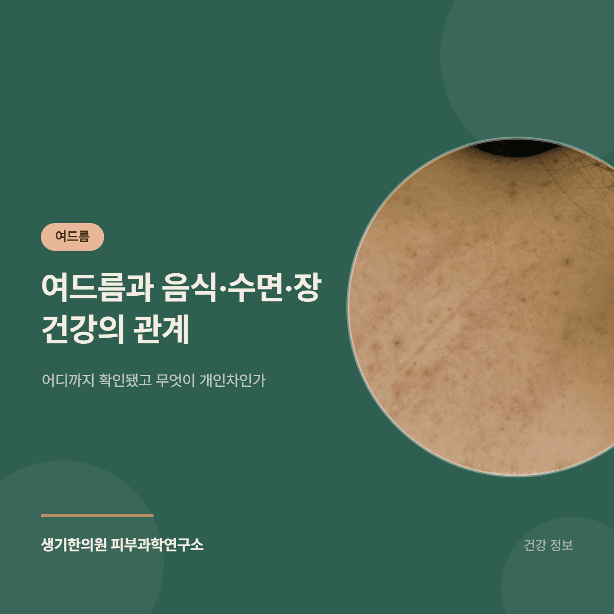 여드름과 음식·수면·장 건강의 관계 — 어디까지 확인됐고 무엇이 개인차인가 대표 이미지