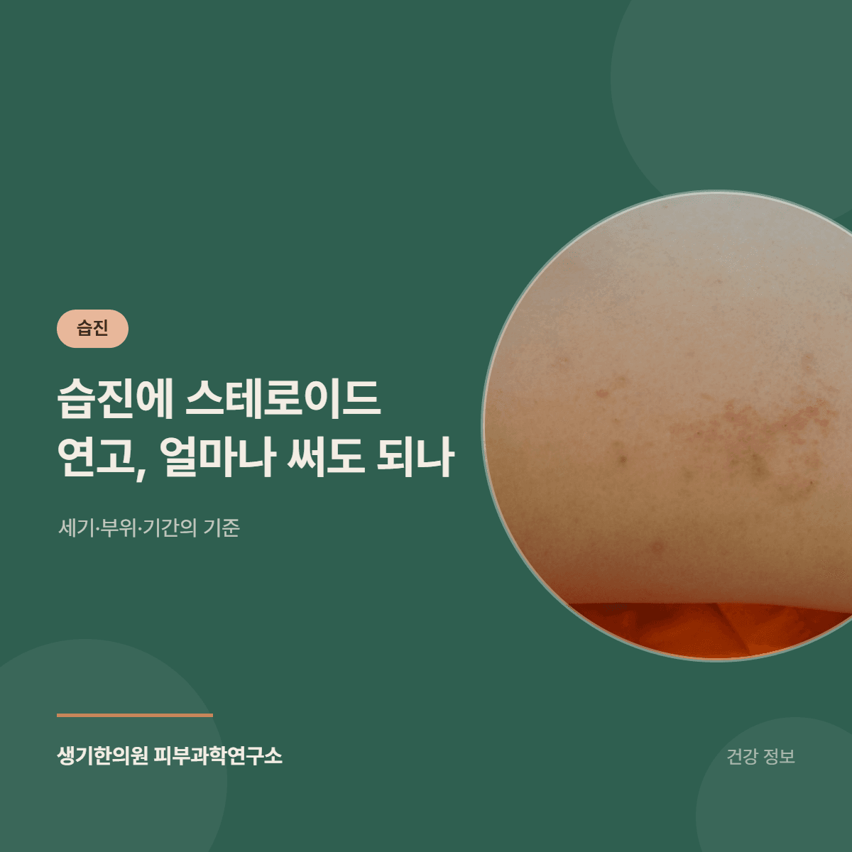습진에 스테로이드 연고, 얼마나 써도 되나 — 세기·부위·기간의 기준 대표 이미지