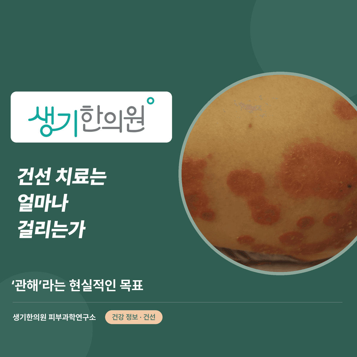 건선 치료는 얼마나 걸리는가 — ‘관해’라는 현실적인 목표 대표 이미지