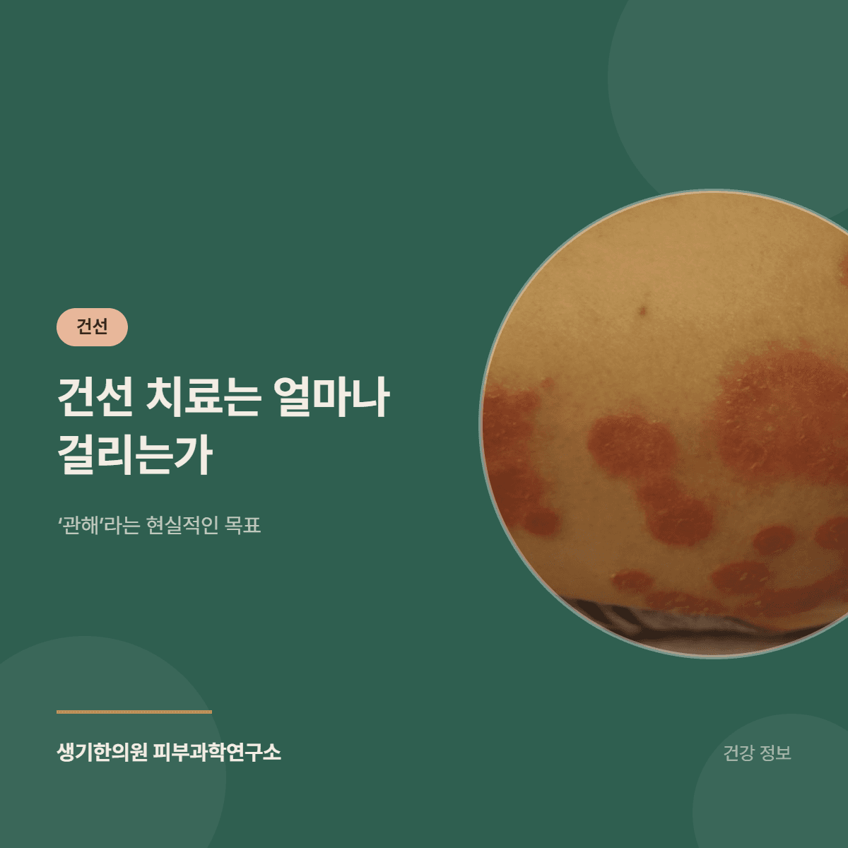 건선 치료는 얼마나 걸리는가 — ‘관해’라는 현실적인 목표 대표 이미지