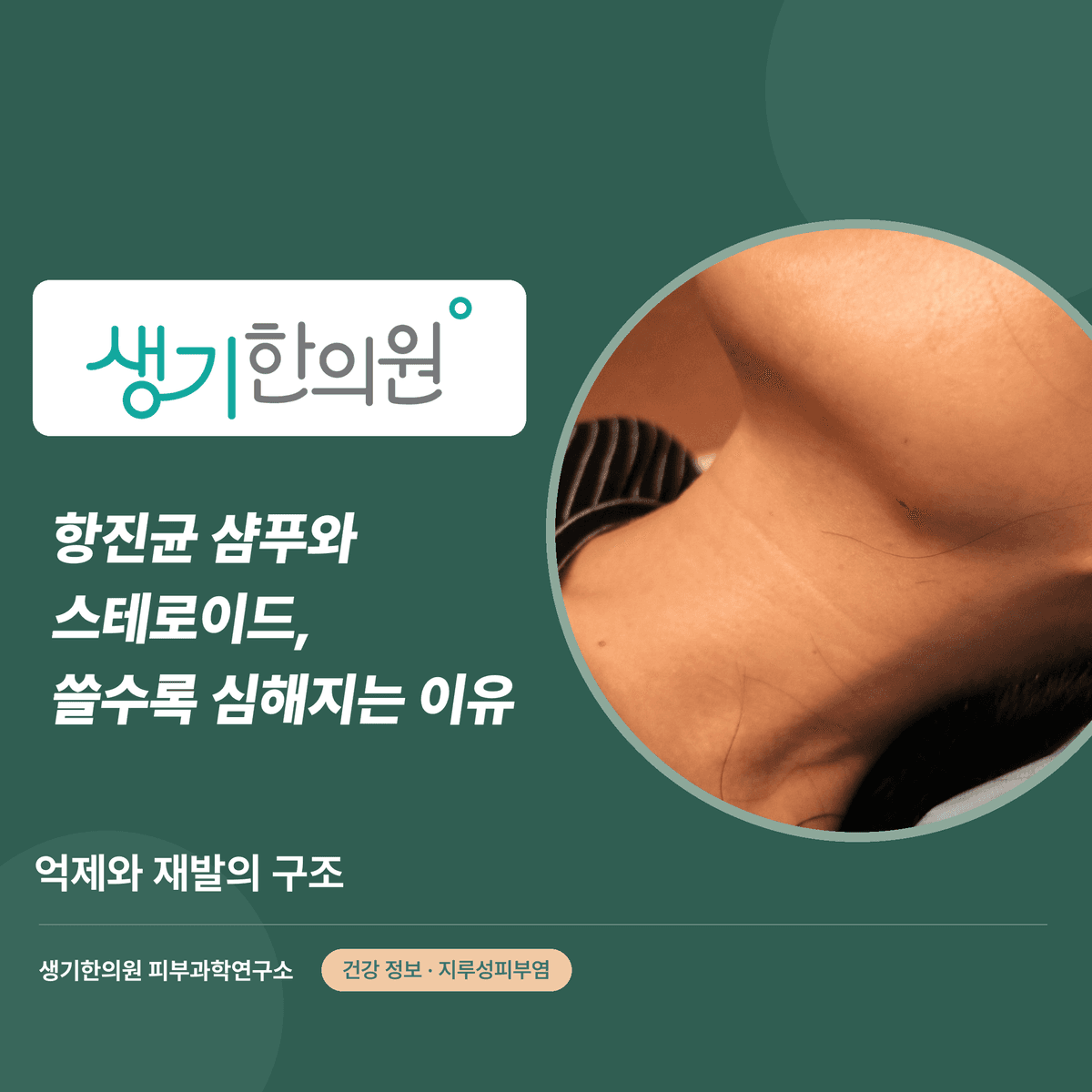 항진균 샴푸와 스테로이드, 쓸수록 심해지는 이유 — 억제와 재발의 구조 대표 이미지