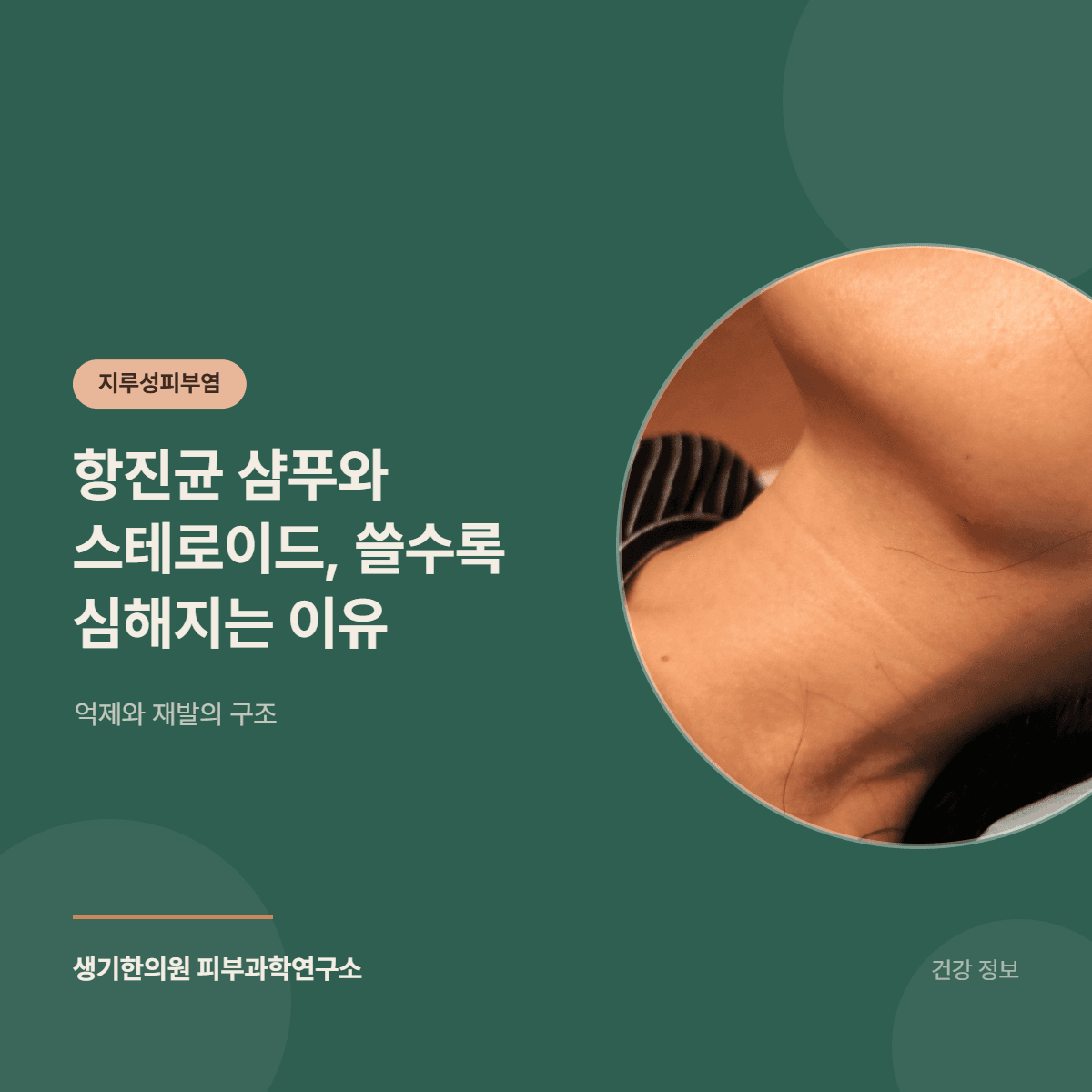 항진균 샴푸와 스테로이드, 쓸수록 심해지는 이유 — 억제와 재발의 구조 대표 이미지