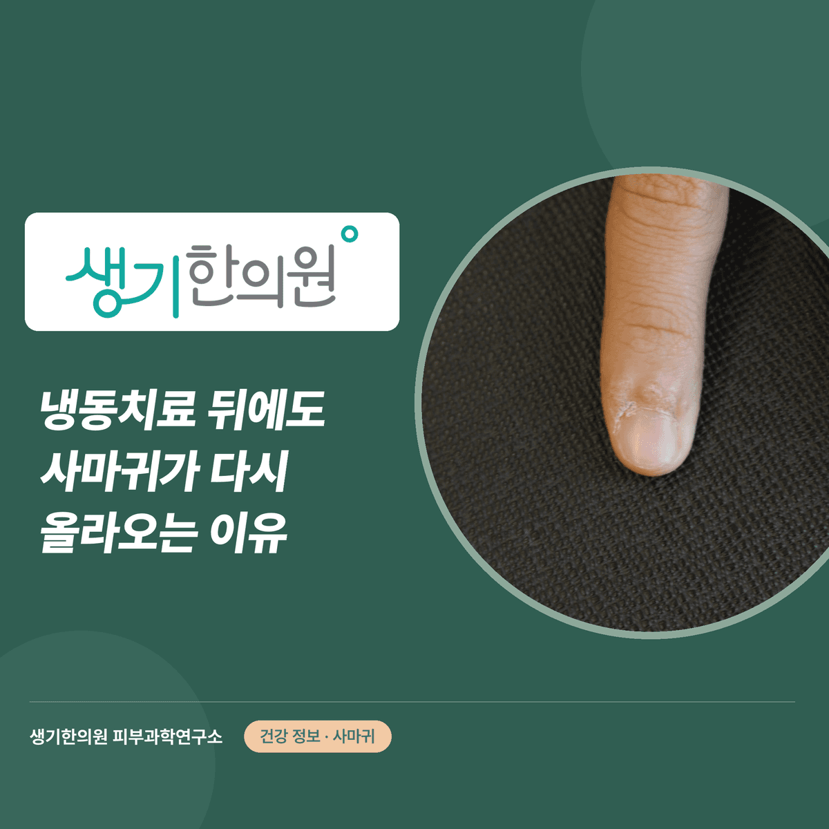 냉동치료 뒤에도 사마귀가 다시 올라오는 이유 대표 이미지