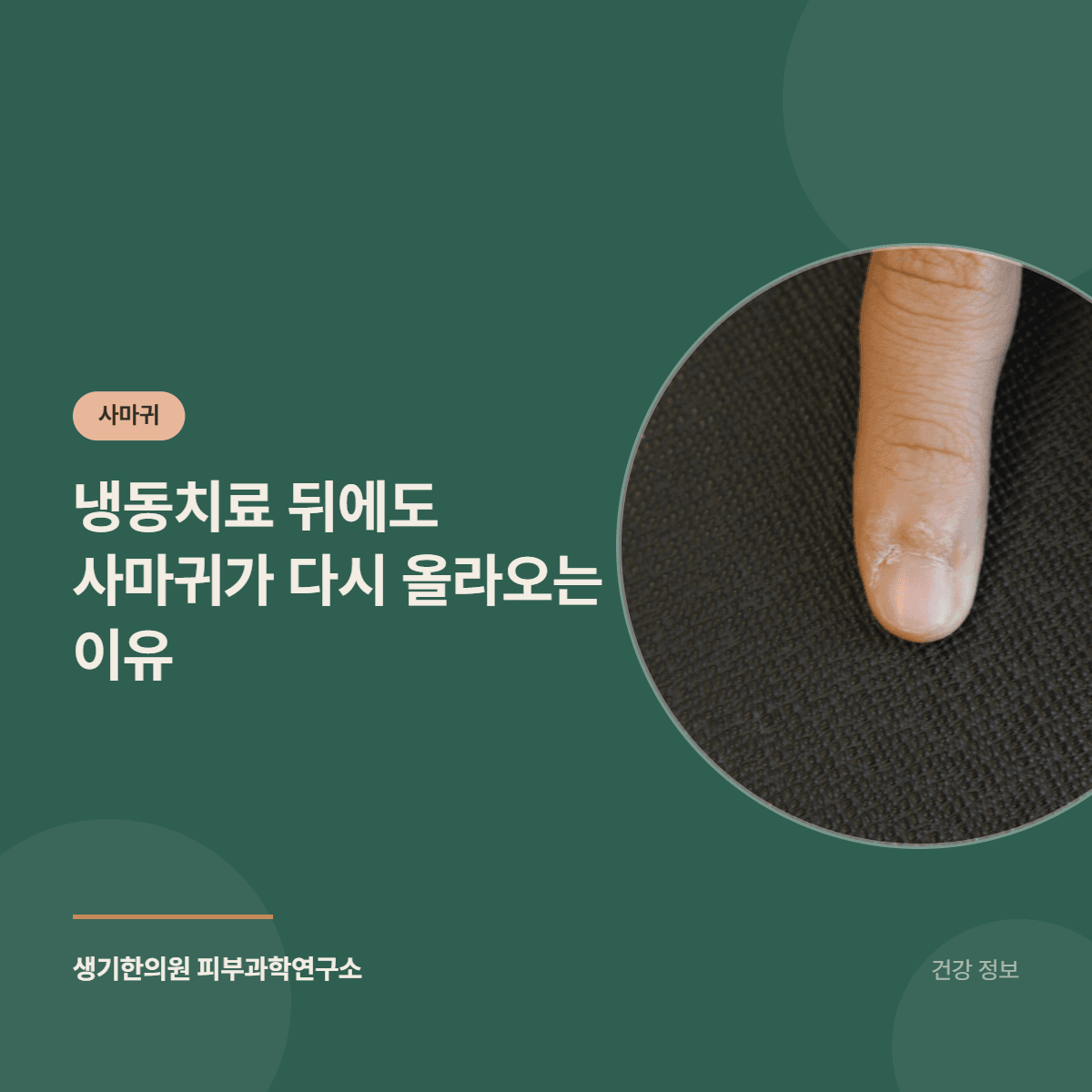 냉동치료 뒤에도 사마귀가 다시 올라오는 이유 대표 이미지