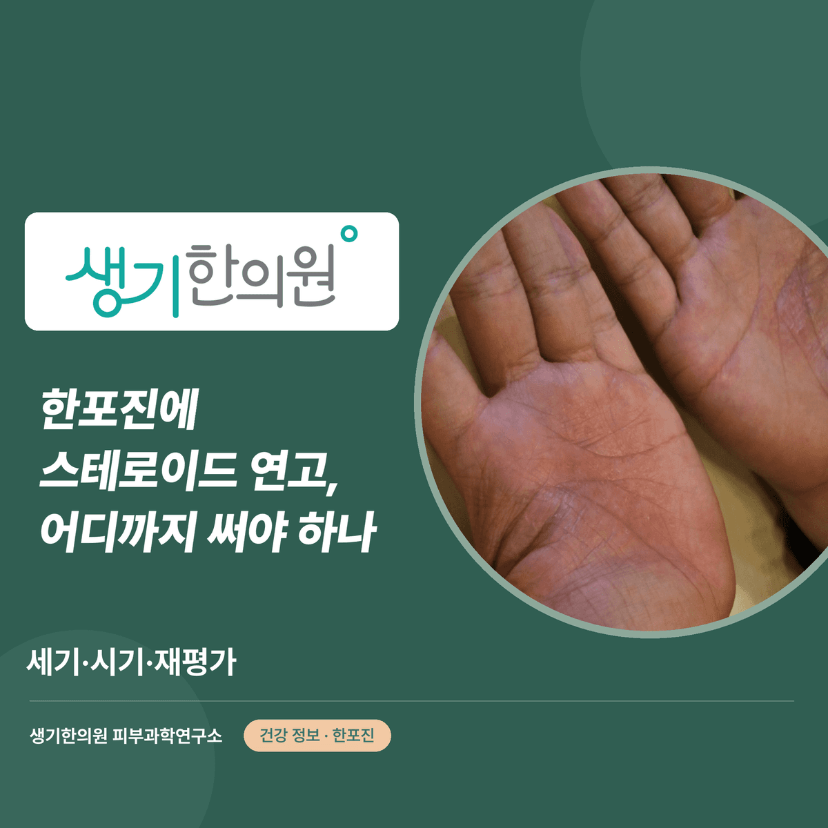 한포진에 스테로이드 연고, 어디까지 써야 하나 — 세기·시기·재평가 대표 이미지