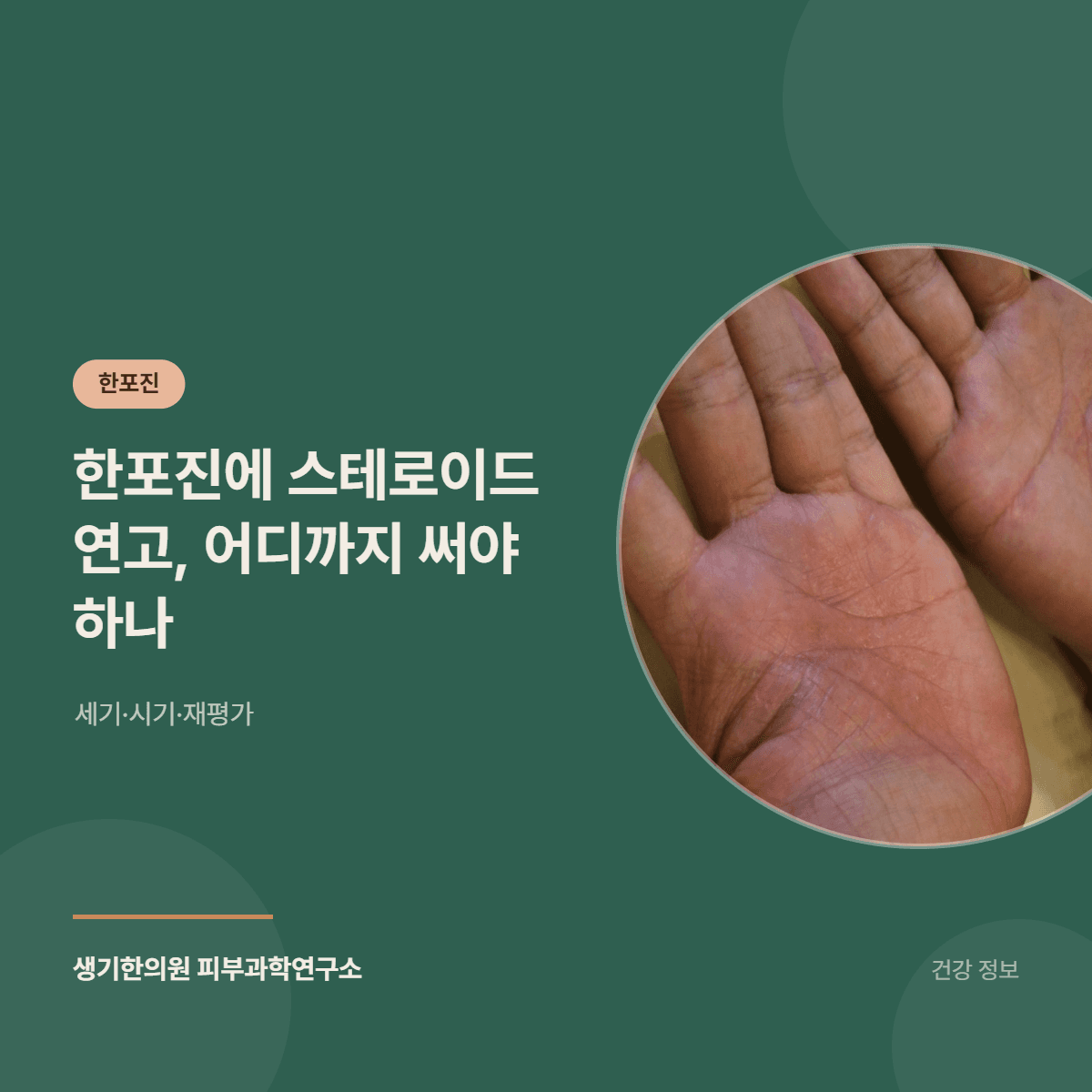 한포진에 스테로이드 연고, 어디까지 써야 하나 — 세기·시기·재평가 대표 이미지