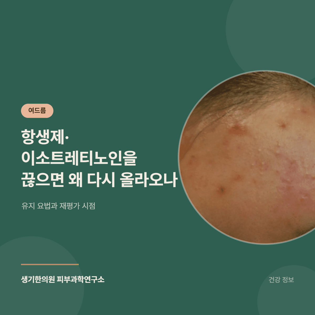 항생제·이소트레티노인을 끊으면 왜 다시 올라오나 — 유지 요법과 재평가 시점 대표 이미지