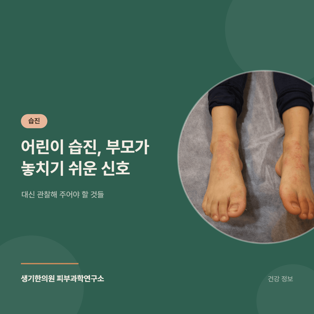 어린이 습진, 부모가 놓치기 쉬운 신호 — 대신 관찰해 주어야 할 것들 대표 이미지