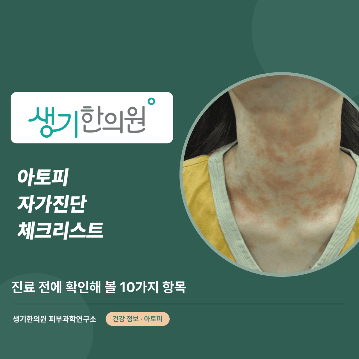 아토피 자가진단 체크리스트 — 진료 전에 확인해 볼 10가지 항목 대표 이미지