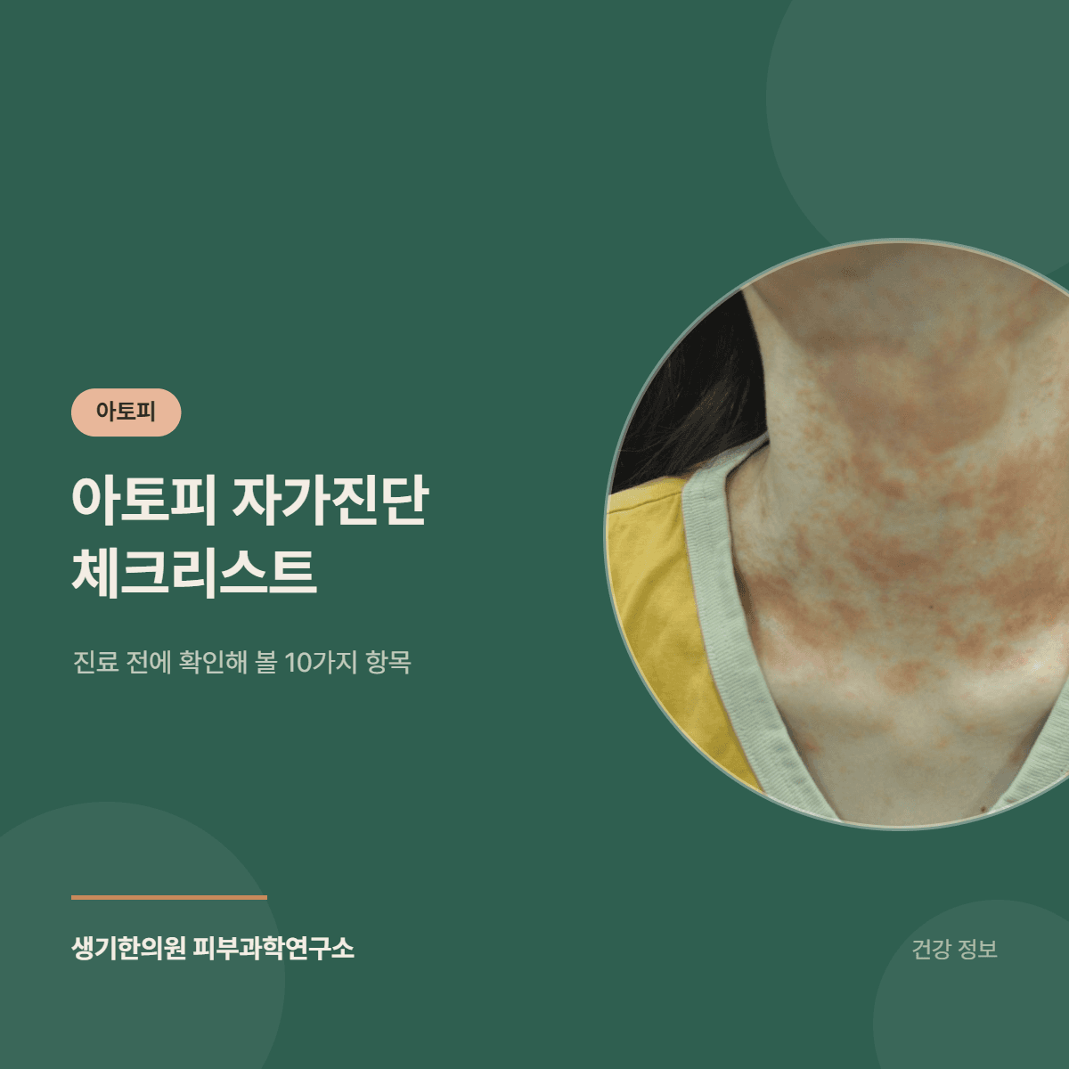 아토피 자가진단 체크리스트 — 진료 전에 확인해 볼 10가지 항목 대표 이미지