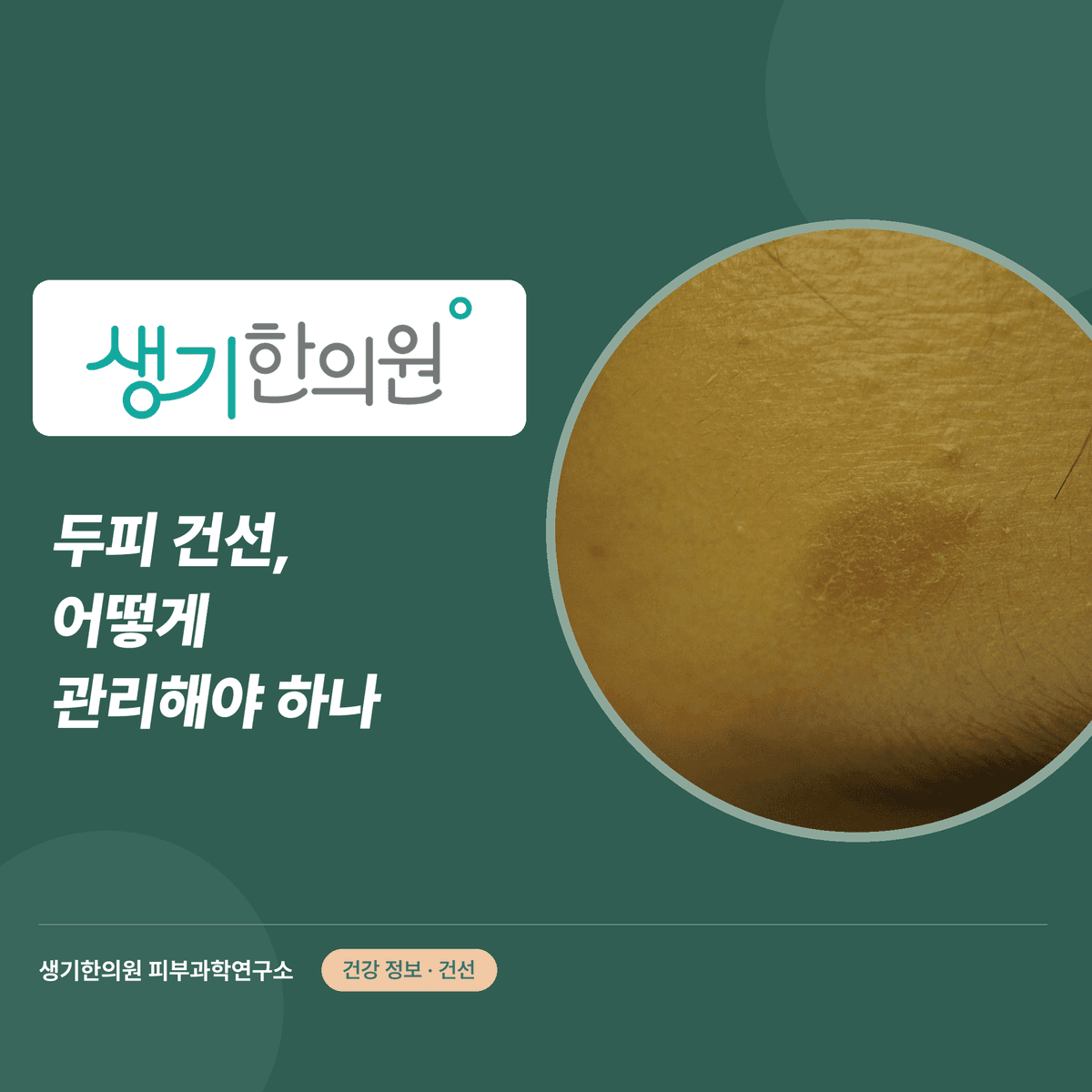 두피 건선, 어떻게 관리해야 하나 대표 이미지