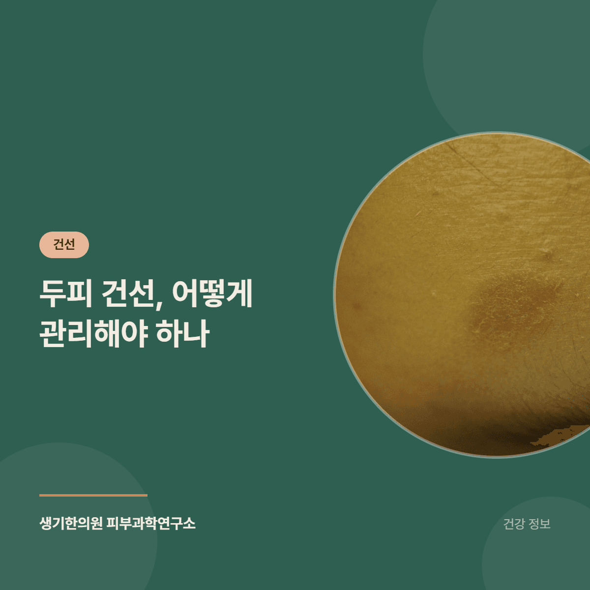 두피 건선, 어떻게 관리해야 하나 대표 이미지