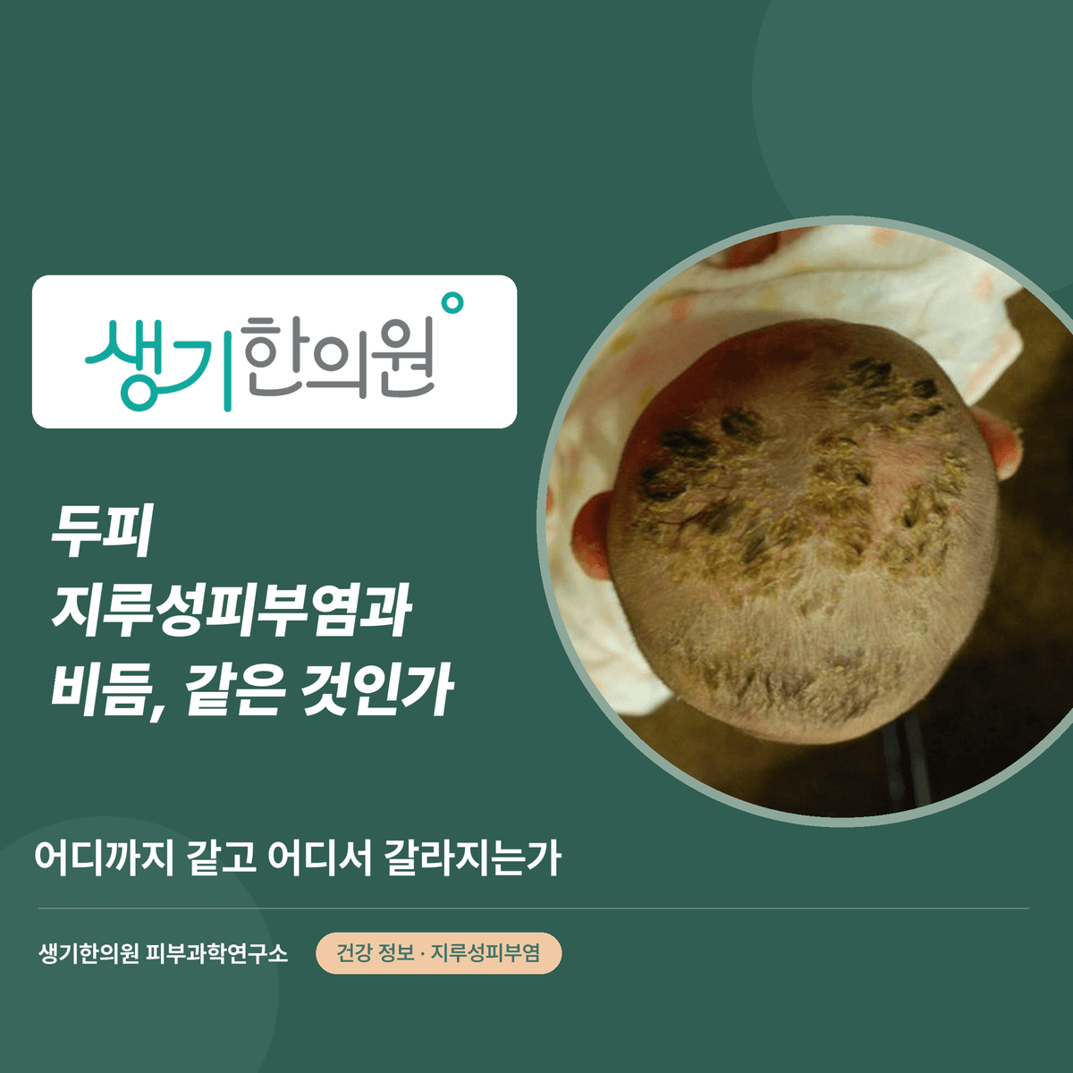 두피 지루성피부염과 비듬, 같은 것인가 — 어디까지 같고 어디서 갈라지는가 대표 이미지