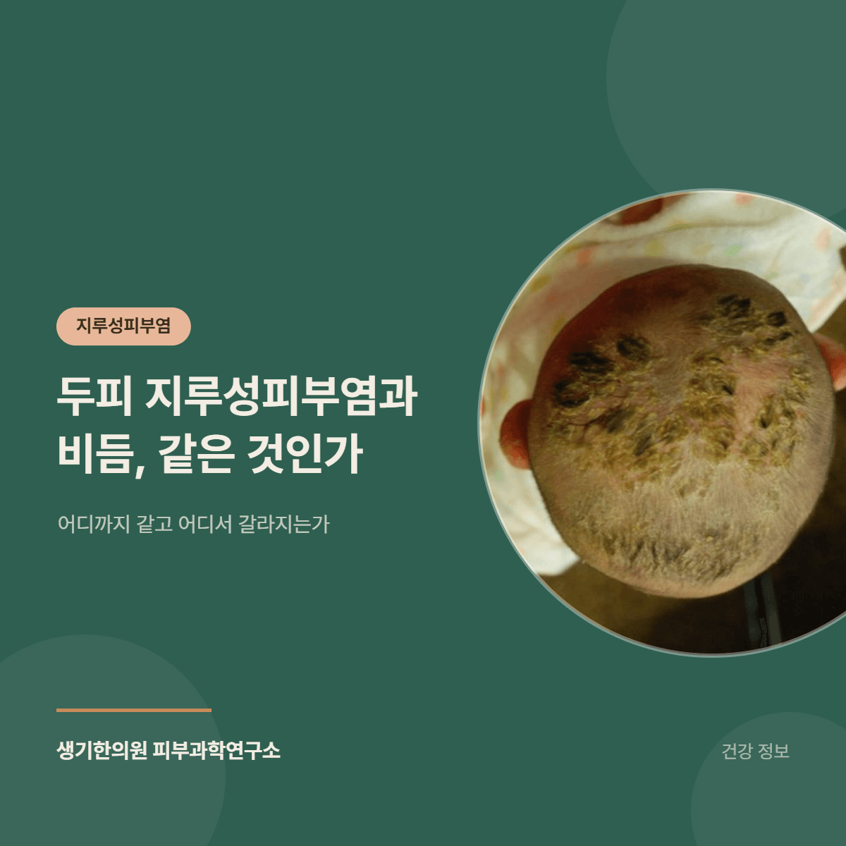두피 지루성피부염과 비듬, 같은 것인가 — 어디까지 같고 어디서 갈라지는가 대표 이미지