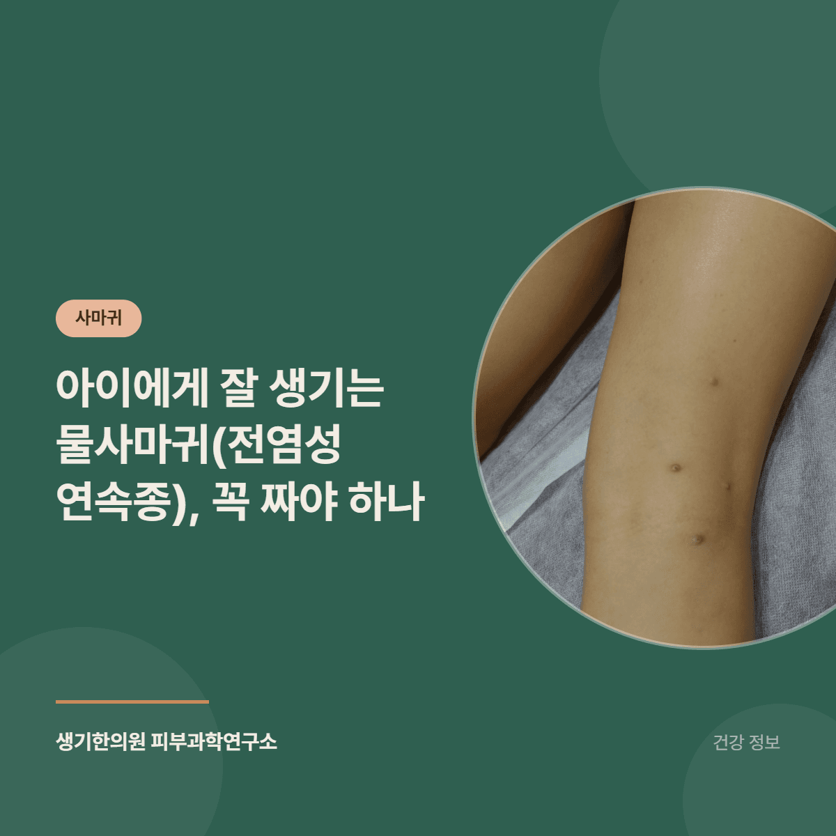 아이에게 잘 생기는 물사마귀(전염성 연속종), 꼭 짜야 하나 대표 이미지