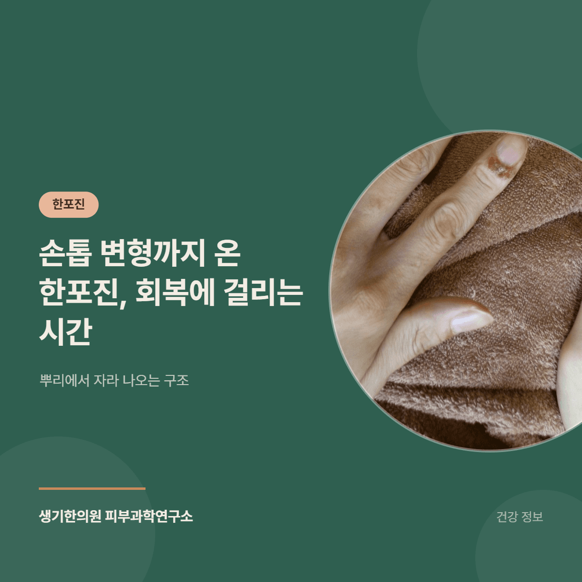 손톱 변형까지 온 한포진, 회복에 걸리는 시간 — 뿌리에서 자라 나오는 구조 대표 이미지
