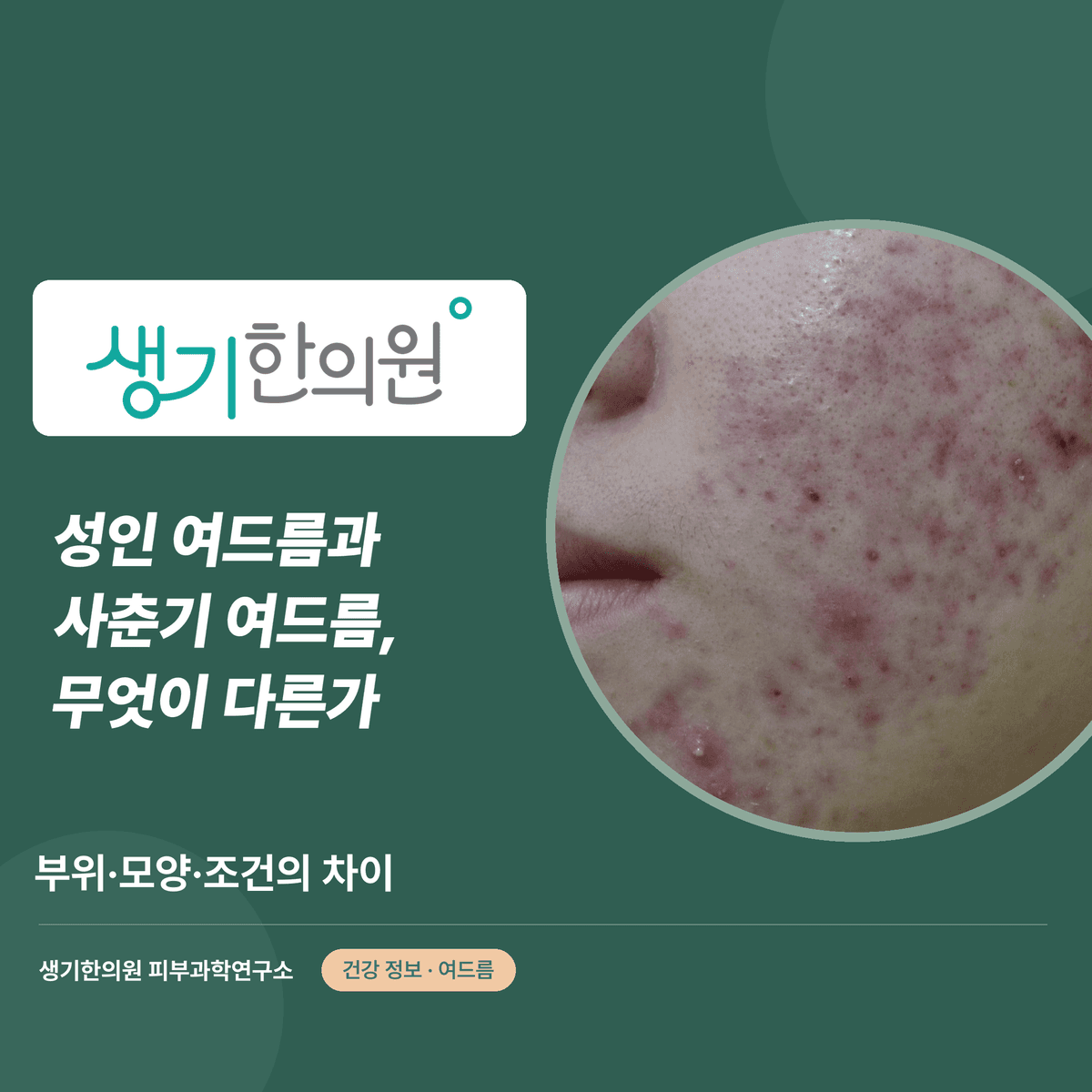 성인 여드름과 사춘기 여드름, 무엇이 다른가 — 부위·모양·조건의 차이 대표 이미지