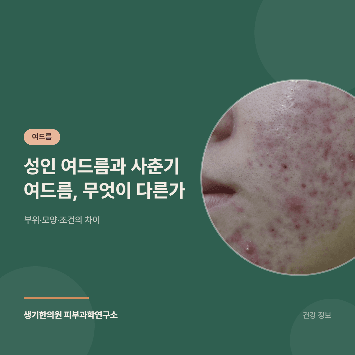 성인 여드름과 사춘기 여드름, 무엇이 다른가 — 부위·모양·조건의 차이 대표 이미지